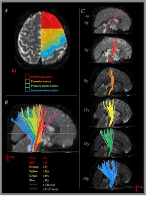 The Change of Intra-cerebral CST Location during Childhood and Adolescence; Diffusion Tensor Tractography Study